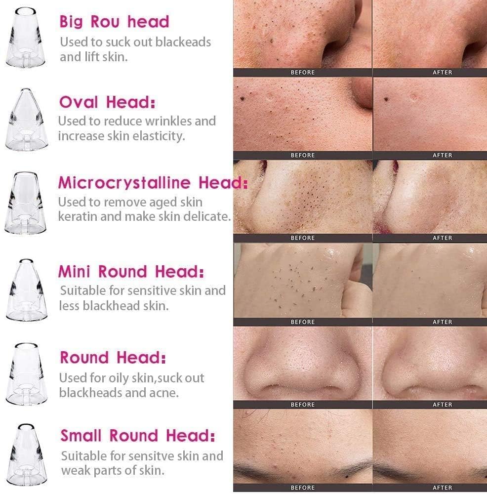 Black head remover